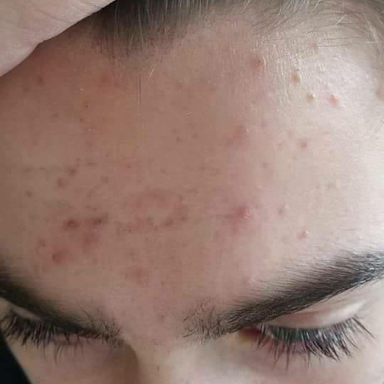 Acne before